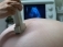Analize prenatale: sumarul de urina
